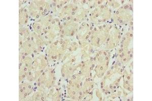 Immunohistochemistry of paraffin-embedded human gastric cancer using ABIN7151953 at dilution of 1:100 (Eppin Antikörper  (AA 22-133))
