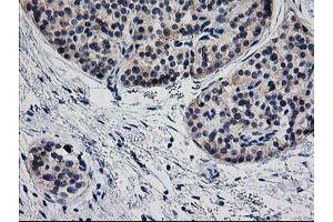 Immunohistochemical staining of paraffin-embedded Carcinoma of Human pancreas tissue using anti-TMOD1 mouse monoclonal antibody. (Tropomodulin 1 Antikörper)