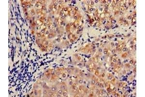 Immunohistochemistry of paraffin-embedded human liver tissue using ABIN7145998 at dilution of 1:100 (CCL3 Antikörper  (AA 25-81))