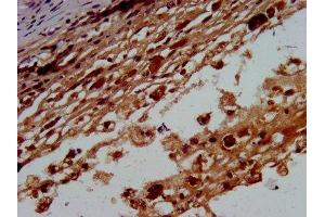 IHC image of ABIN7145615 diluted at 1:400 and staining in paraffin-embedded human melanoma performed on a Leica BondTM system. (BTD Antikörper  (AA 322-397))