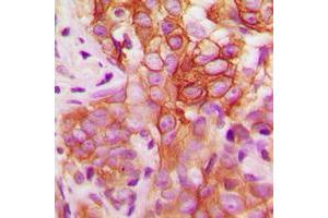 Immunohistochemical analysis of FYN (pY530) staining in human breast cancer formalin fixed paraffin embedded tissue section.
