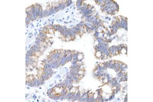 Immunohistochemistry of paraffin-embedded human colon carcinoma using ACADS / SCAD Rabbit mAb (ABIN7265419) at dilution of 1:50 (40x lens). (ACADS Antikörper)