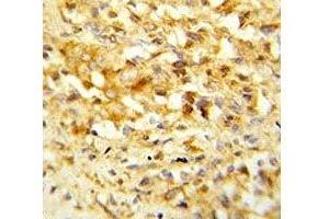 IHC analysis of FFPE human prostate carcinoma stained with NKX3. (NKX3-1 Antikörper  (AA 118-145))