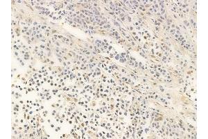 ABIN6266072 and ABIN6266816 at 1/100 staining human non-Hodgkin lymphoma by IHC-P. (XRN2 Antikörper  (N-Term))