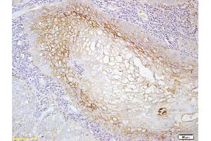 Formalin-fixed and paraffin embedded human laryngeal cancer labeled with Anti-MCSF ReceptorPolyclonal Antibody, Unconjugated (ABIN750143) at 1:200 followed by conjugation to the secondary antibody and DAB staining (CSF1R Antikörper  (AA 201-300))