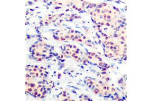 Immunohistochemical analysis of paraffin-embedded human breast carcinoma tissue using JunD (Ab-255) antibody (#B7137). (JunD Antikörper  (Ser255))