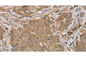 Immunohistochemistry of paraffin-embedded Human cervical cancer tissue using RNF148 Polyclonal Antibody at dilution 1:45 (RNF148 Antikörper)