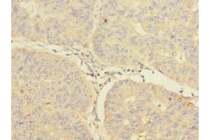 Immunohistochemistry of paraffin-embedded human endometrial cancer using ABIN7148571 at dilution of 1:100 (CIR1 Antikörper  (AA 1-160))