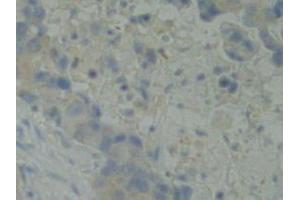 IHC-P analysis of Human Breast Cancer Tissue, with DAB staining. (BMX Antikörper  (AA 287-523))