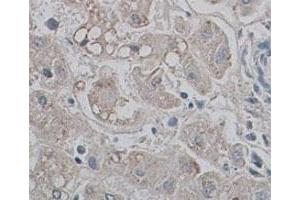 Immunohistochemical staining of formalin-fixed paraffin-embedded human liver tissue showing membrane staining with AQP9 polyclonal antibody  at 1 : 100 dilution. (AQP9 Antikörper  (N-Term))
