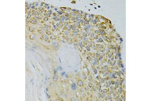 Immunohistochemistry of paraffin-embedded human esophageal cancer using GPX4 Antibody (ABIN5970997) at dilution of 1/200 (40x lens). (GPX4 Antikörper)