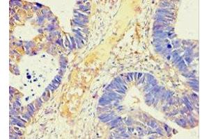 Immunohistochemistry of paraffin-embedded human ovarian cancer using ABIN7143846 at dilution of 1:100 (AMY2B Antikörper  (AA 16-320))