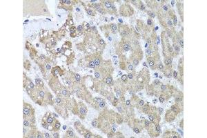 Immunohistochemistry of paraffin-embedded Human liver damage using ALKBH4 Polyclonal Antibody at dilution of 1:100 (40x lens). (ALKBH4 Antikörper)