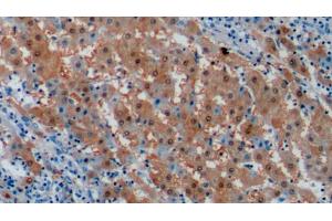 Detection of ARG in Human Liver cancer Tissue using Monoclonal Antibody to Arginase (ARG) (ARG Antikörper  (AA 1-322))