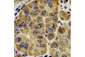 Immunohistochemical analysis of Centrin-1 staining in human liver cancer formalin fixed paraffin embedded tissue section.