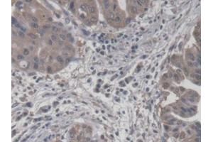IHC-P analysis of Human Liver cancer Tissue, with DAB staining. (CROT Antikörper  (AA 410-612))