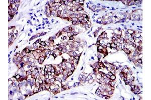 Immunohistochemical analysis of paraffin-embedded human bladder cancer tissues using KRT19 mouse mAb with DAB staining. (Cytokeratin 19 Antikörper)