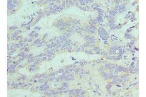 Immunohistochemistry of paraffin-embedded human colon cancer using ABIN7152772 at dilution of 1:100 (FGF1 Antikörper  (AA 16-155))