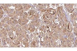 ABIN6269002 at 1/100 staining Human Melanoma tissue by IHC-P. (COL2A1 Antikörper  (N-Term))