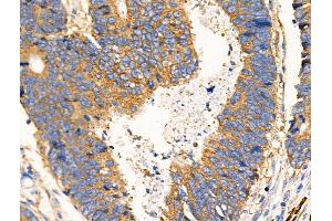 ABIN6259147 and ABIN6274943 at 1/100 staining Human colorectal cancer by IHC-P. (PDE4C Antikörper  (Internal Region))