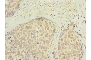 Immunohistochemistry of paraffin-embedded human gastric cancer using ABIN7145334 at dilution of 1:100 (SLC22A18AS Antikörper  (AA 1-150))