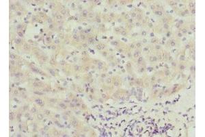 Immunohistochemistry of paraffin-embedded human liver cancer using ABIN7146346 at dilution of 1:100 (CALCOCO1 Antikörper  (AA 462-691))