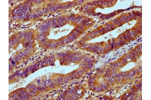 IHC image of ABIN7168103 diluted at 1:300 and staining in paraffin-embedded human colon cancer performed on a Leica BondTM system.