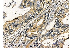 ABIN7095313 and ABIN7099370 at 1/100 staining human pancreatic cancer by IHC-P. (C2CD2 Antikörper)
