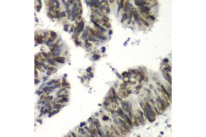 Immunohistochemistry of paraffin-embedded human colon carcinoma using TEAD1 antibody at dilution of 1:100 (x40 lens). (TEAD1 Antikörper)