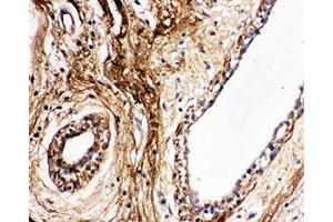 IHC-P: Protein C antibody testing of human breast cancer tissue (PROC Antikörper  (AA 446-461))