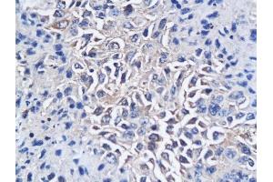 Formalin-fixed and paraffin embedded mouse hepatic tumor labeled with Anti-CD150/SLAMF1 Polyclonal Antibody, Unconjugated followed by conjugation to the secondary antibody and DAB staining (SLAMF1 Antikörper  (AA 231-335))
