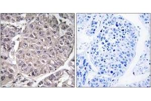 Immunohistochemistry analysis of paraffin-embedded human liver carcinoma tissue, using APOL4 Antibody.