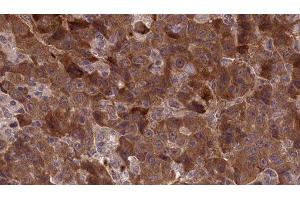 ABIN6277306 at 1/100 staining Human liver cancer tissue by IHC-P. (APLP1 Antikörper  (Internal Region))