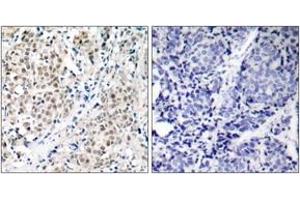 Immunohistochemistry analysis of paraffin-embedded human breast carcinoma tissue, using MYC (Ab-358) Antibody. (c-MYC Antikörper  (AA 325-374))