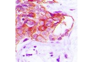 Immunohistochemical analysis of CADM2 staining in human prostate cancer formalin fixed paraffin embedded tissue section. (CADM2 Antikörper)