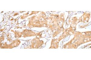 Immunohistochemistry of paraffin-embedded Human breast cancer tissue using GRAP Polyclonal Antibody at dilution of 1:40(x200)