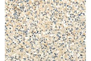 The image on the left is immunohistochemistry of paraffin-embedded Human prostate cancer tissue using ABIN7190020(BRWD1 Antibody) at dilution 1/20, on the right is treated with synthetic peptide. (BRWD1 Antikörper)