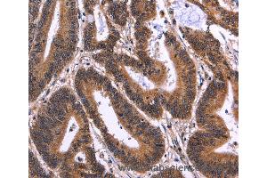 Immunohistochemistry of Human cervical cancer using MSH4 Polyclonal Antibody at dilution of 1:50 (MSH4 Antikörper)