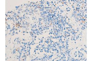 ABIN6255167 and ABIN6267222 at 1/100 staining rat cancer tissue sections by IHC-P. (CHEK1 Antikörper  (pSer286))