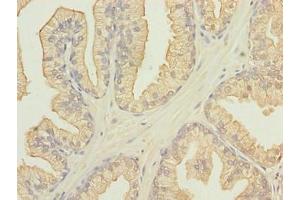 Immunohistochemistry of paraffin-embedded human prostate cancer using ABIN7165562 at dilution of 1:100 (FAM78A Antikörper  (AA 21-283))