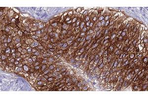 ABIN6275913 at 1/100 staining Human urothelial cancer tissue by IHC-P. (Adenosine A2a Receptor Antikörper  (Internal Region))