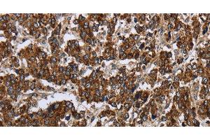 Immunohistochemistry of paraffin-embedded Human liver cancer using PPP1R13L Polyclonal Antibody at dilution of 1:30 (PPP1R13L Antikörper)