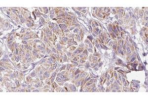 ABIN6277153 at 1/100 staining Human Melanoma tissue by IHC-P. (IL-10 Antikörper  (Internal Region))