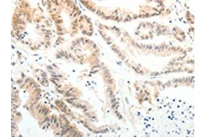 The image on the left is immunohistochemistry of paraffin-embedded Human colon cancer tissue using ABIN7189608(ABL2 Antibody) at dilution 1/25, on the right is treated with synthetic peptide. (ABL2 Antikörper)
