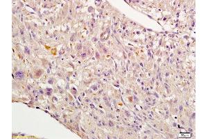 Formalin-fixed and paraffin embedded human endometrial cancer labeled with Rabbit Anti-Nrf2 Polyclonal Antibody, Unconjugated (ABIN737271) 1:200 followed by conjugation to the secondary antibody and DAB staining (NRF2 Antikörper  (AA 430-480))