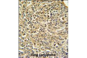 Merlin Antibody IHC analysis in formalin fixed and paraffin embedded human lung carcinoma followed by peroxidase conjugation of the secondary antibody and DAB staining.