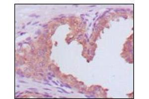 Immunohistochemical analysis of paraffin-embedded human prostate carcinoma tissues, showing cytoplasmic localization using KLK3 mouse mAb with DAB staining. (Prostate Specific Antigen Antikörper  (AA 26-251))