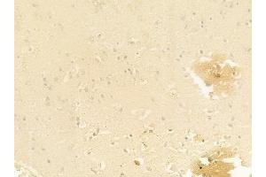 ABIN6261919 and ABIN6278467 at 1/100 staining human glioblastoma by IHC-P. (GCLC Antikörper  (N-Term))