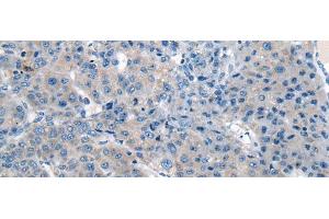 Immunohistochemistry of paraffin-embedded Human liver cancer tissue using CITED4 Polyclonal Antibody at dilution of 1:65(x200) (CITED4 Antikörper)