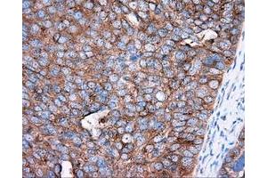 Immunohistochemical staining of paraffin-embedded Adenocarcinoma of colon tissue using anti-PRKAR2A mouse monoclonal antibody. (PRKAR2A Antikörper)
